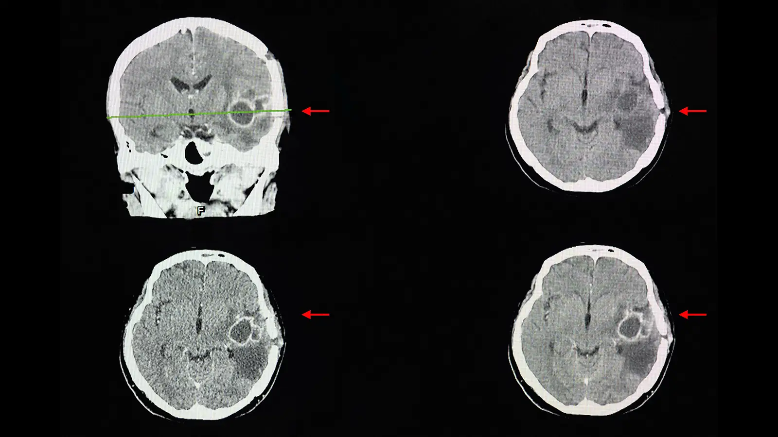 CDC Warns on Rise in Deadly Fungal Infections That Spread to the Brain - MedPage Today