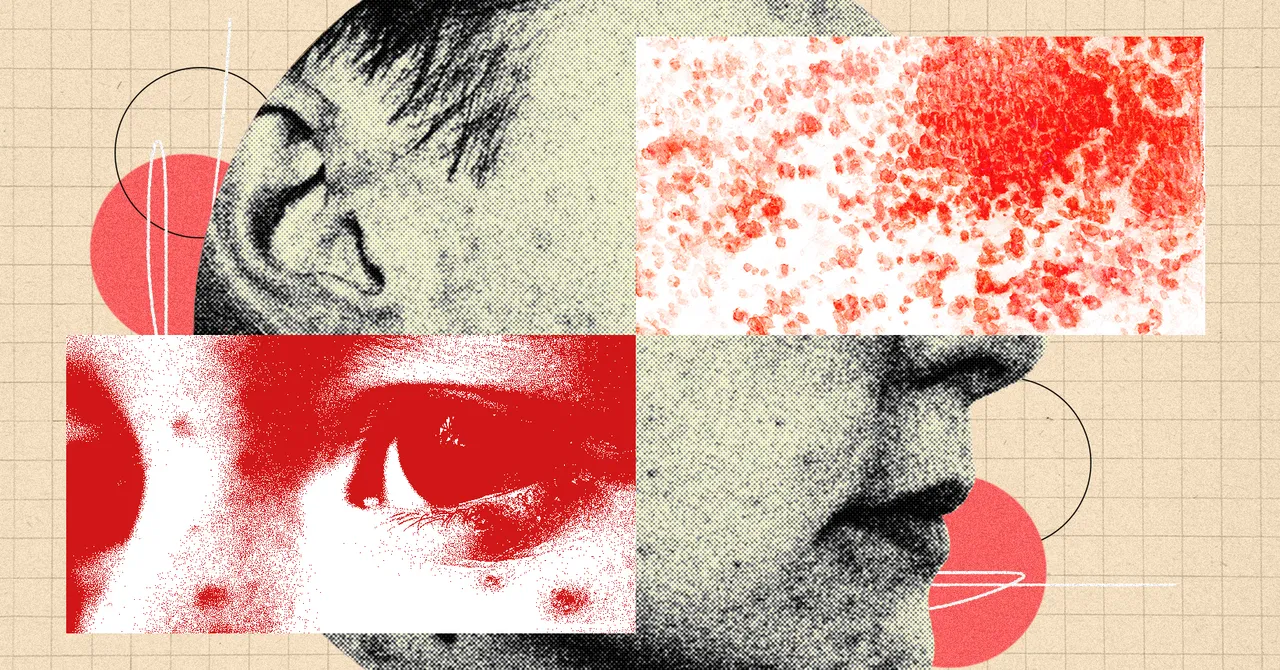 You Need to Be More Freaked Out by Shingles - WIRED